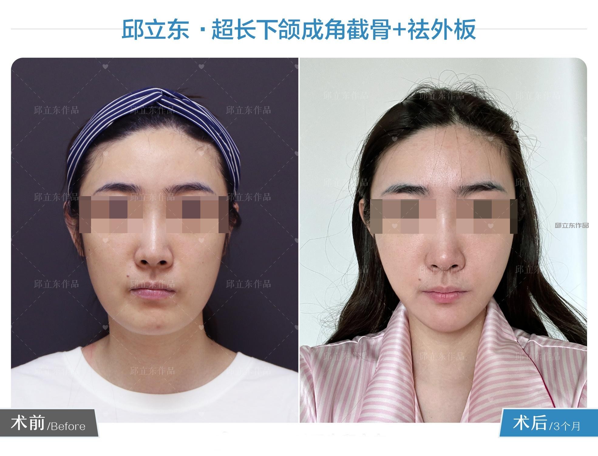 邱立东怎么样？北京磨骨改轮廓专家技术测评！