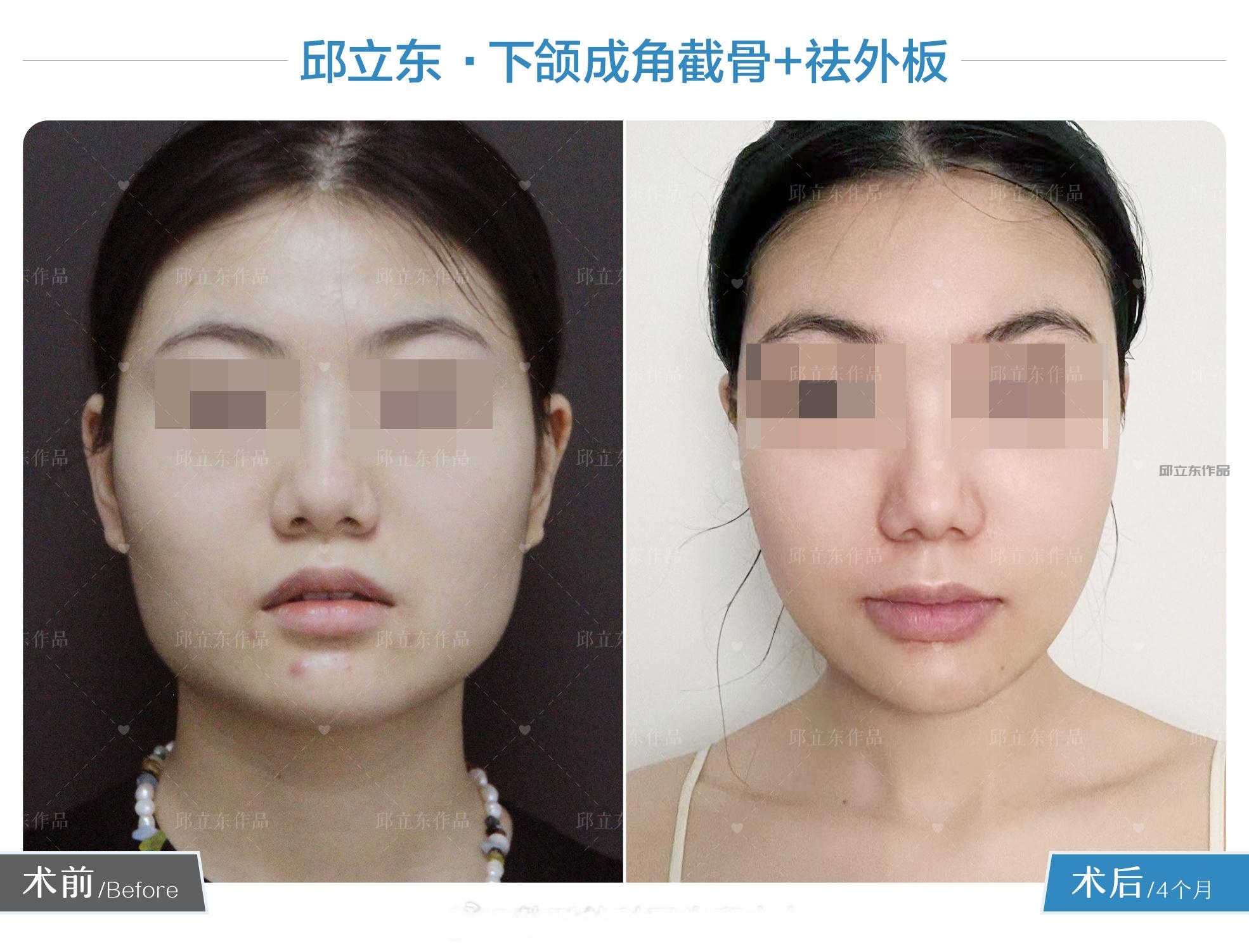 下颌角手术的适应人群?什么人不适合做？医生该如何选择？