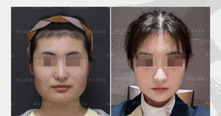 国字脸磨骨手术术后效果揭秘：真实案例与专业分析